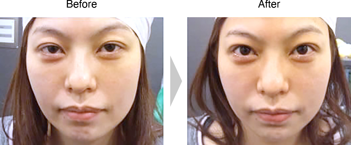 二重まぶた＋眼瞼下垂（切開なし）症例1
