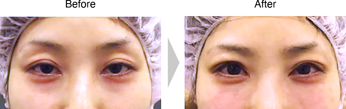 二重まぶた＋眼瞼下垂（切開なし）症例2