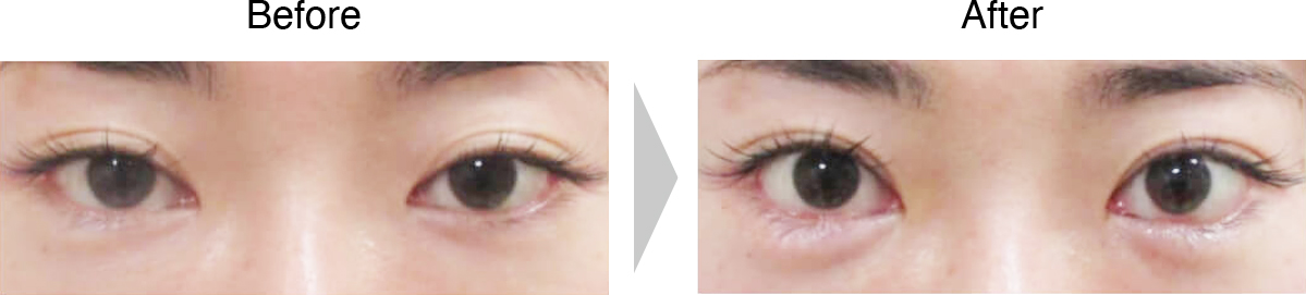 下眼瞼　グラマラスライン症例1