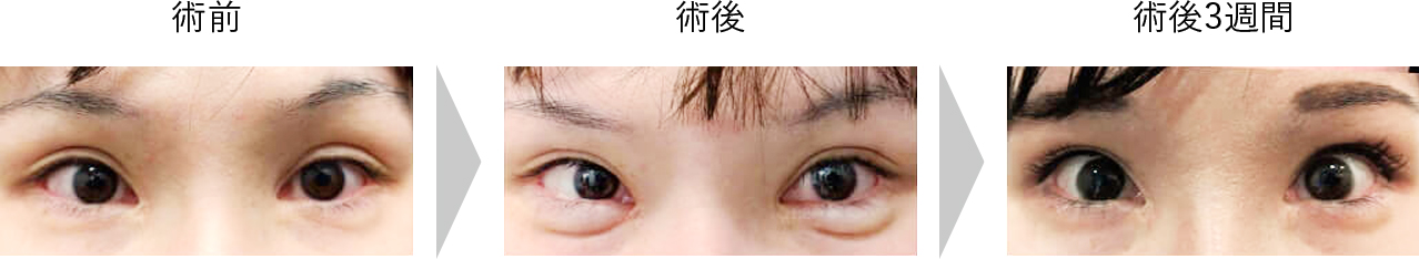 下眼瞼　グラマラスライン症例2